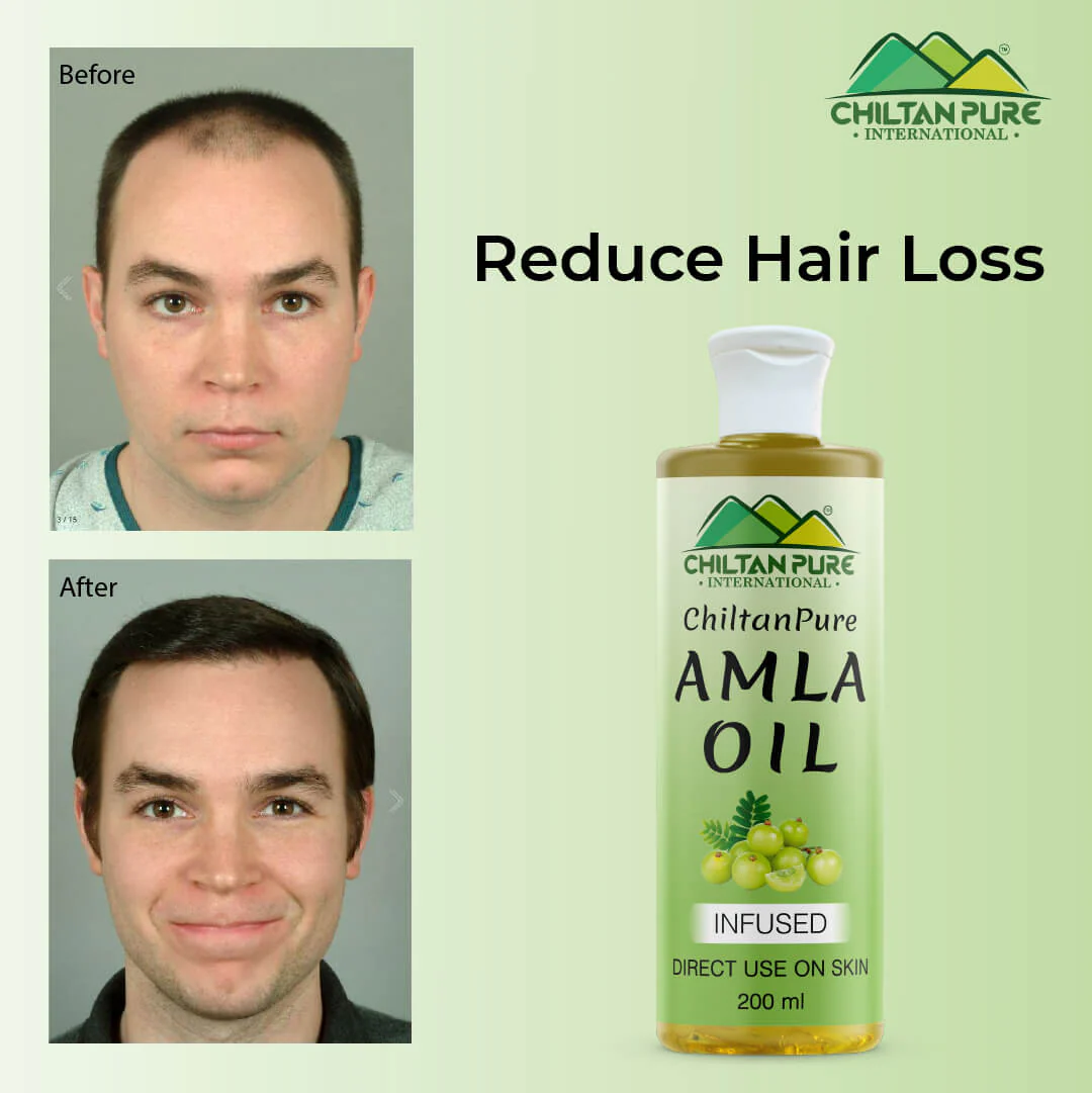 Amla Oil – Lessen Hair Loss, Boosts Hair Growth, Treats Dry Scalp & Prevents Premature Hair Greying - Image 6