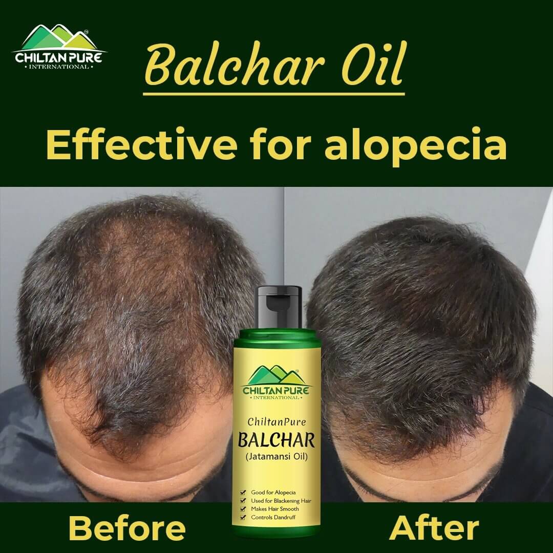 Balchar (Jatamansi) Oil – Effective for Alopecia, Enlarges Follicular Hair Size & Prevents Scalp Infections - Image 4