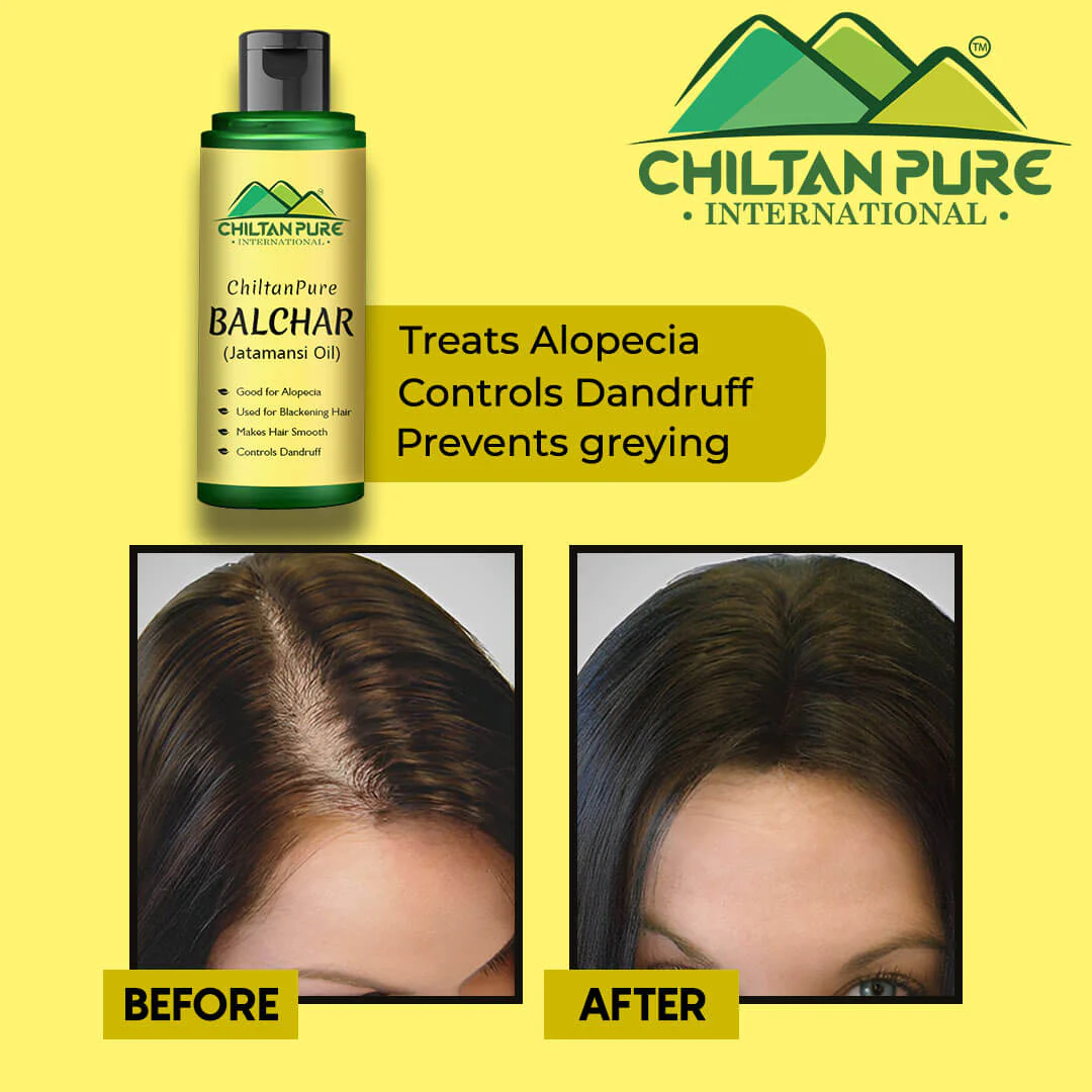 Balchar (Jatamansi) Oil – Effective for Alopecia, Enlarges Follicular Hair Size & Prevents Scalp Infections - Image 6
