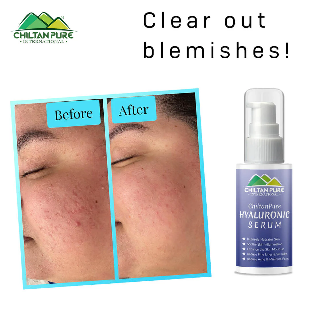 Hyaluronic Acid Serum – Treats wrinkles & Acne, Best at Hydrating Skin For Smooth and Radiant Skin 50ml - Image 4