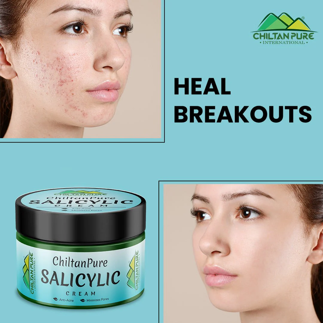 Salicylic Cream – Exfoliates Skin, Anti-Acne, Lighten Acne Scars, Makes Skin Healthy & Glowing - Image 2